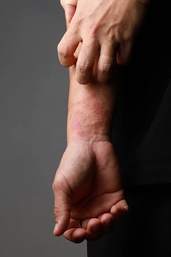 Eczema-Treatment One hand scratches an area irritated by eczema on the other wrist. Get treatment for eczema from Dr. Donna Diamond in Louisville/Boulder.
