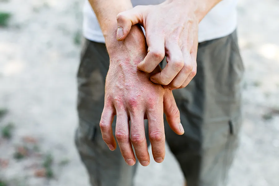 Psoriasis-Clinic Close-up of a man scratching his hands while experiencing Psoriasis. Get care for Psoriasis from Dr. Donna Diamond in Louisville/Boulder.
