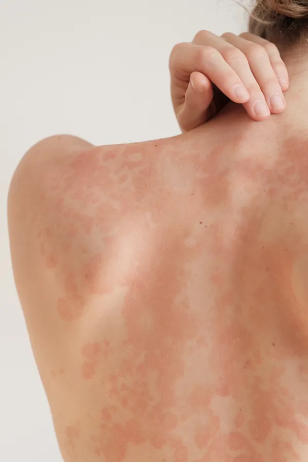 Psoriasis-Treatment The back and shoulder of a woman experiencing Psoriasis. Get treatment for Psoriasis from Dr. Donna Diamond in Louisville/Boulder.