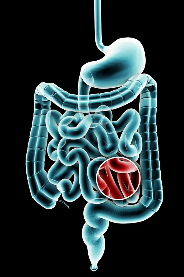 Ulcerative-Colitis-Treatment 3D illustration of the digestive system in blue tones, with an area of discomfort in red tones. Get treatment for Ulcerative Colitis from Dr. Donna Diamond in Louisville/Boulder.